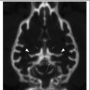 CT와 MRI를 통한 quadrigeminal cistern 해부와 supracollicular fluid accumulation 특징 이미지