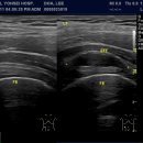 Effusion on anterior femoral neck joint 이미지