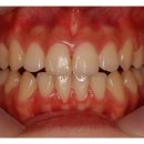 치아미백비용 누런 치아의 치아미백을 통한 해결 (치아미백가격/치아미백) 이미지