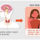 갑상선 기능 항진증 증상 치료, 음식 (갑상샘항진증, 안구돌출 눈) 이미지