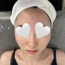 일산 여드름 관리 피부과 /에셀스킨 여드름 관리 2회 후기 / 정발산 피부관리샵 추천