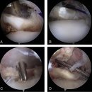 Re: 견갑하 건 손상. 2018 이미지