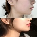 서현한의원 | 서현역한의원 분당리프팅 2회차 후기! 이중턱 얼굴살 고민 해결