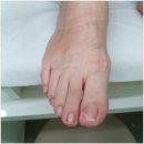 구로역 서울늘봄메디칼의원 내성발톱 치료 너무 만족스러워요 !! 직장인 맞춤 치료도 굿 !!