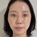 포텐 | 압구정피부과 포텐리쥬베룩 내돈내산후기(모공 스트레스 해결)