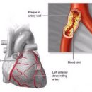 고지혈증과 콜레스테롤, LDL Cholesterol, HDL Cholesterol 이미지