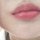 탐의원 | 청주입술필러 아티움의원 입술필러 1~4일차 후기