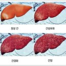 나도 모르게 간을 망가뜨리는 생활 습관 이미지