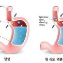 목에 이물감 원인과 통증 목에 뭐가 걸린느낌 해결방법 이미지