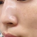 비채움뷰티 | 부평피부관리 모공청소로 깨끗해진 후기 :: 비채움뷰티어겐