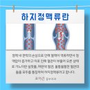 손이나 발에 튀어나온 핏줄도 하지정맥류인가요? 이미지