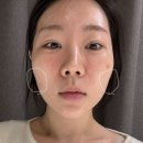 강남역 피부과에서 쥬베룩 볼륨으로 옆볼 채우기 4차 후기!