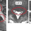 mixedmedia 님의 요추디스크 L4-5의 MRI사진판독입니다. 이미지