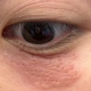 슈퍼스타피부과의원 | 지겨운 한관종 co2 레이저 시술 후기(내돈내산,제발 좀 사라져라🥲)