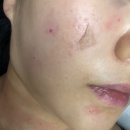 미몽피부과의원 | 회기피부과/ 미몽피부과의원에서 점빼고왔어요