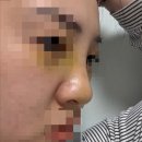 디올림 | 대구 더올림 성형외과 내돈내산 코수술 1주차 후기 | 붓기, 실밥제거, 솔직한 변화💛