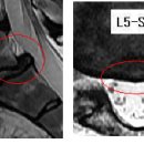000000 님의 척추분리증, 전방전위증 MRI 사진및 판독입니다. 이미지