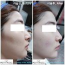 볼필러잘하는병원 전후 후기 더프리티영의원