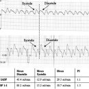 Intraoperative bypass graft flow in intra-aortic balloon pump–supported patients: Differences in arterial and venous sequential conduits 이미지