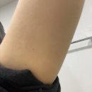 lct 피부과 지방분해주사 3주차 후기 팔뚝살이 쏘옥 빠짐