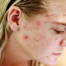 파낙스약국 | 여드름 연고 완벽 정리: 피부과 전문가 추천과 올바른 사용법