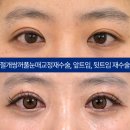 아이케이성형외과의원 네이버블로그