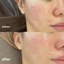 (주)필로메디 | 더노블메디센터ㅣ부산웨딩관리ㅣ동래피부관리ㅣ찐 효과 비교하려고 3일 지나서 쓰는 후기