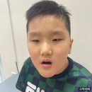 산본1 | [초등교정 1개월 후기] 산본치과 악궁확장장치 착용한 우리 아들 변화!