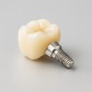 디오(D.O)치과기공소 | 김해치과 임플란트 크라운 교체 가격