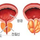 전립선비대증 원인·증상·치료법 이미지