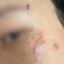 청주 잡티 흑자(오타양반점,오타모반) 제거 토닝 레이저 진행 후기 개인기록