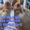 오른쪽 발가락 진동과 열감 공격에 왼쪽에 비해 현저히 부어오르고 빨갛게 변했는데 몹시 가렵고 따가움. 이미지