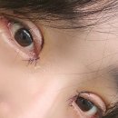 연세미니성형외과의원 | 세종 연세미니성형외과 :: 눈재수술(쌍수) 및 밑뒷트임 후기