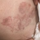 7컬러 | 컬러타투제거 후기 7회차 (타투 지우다가 오히려 더 진해졌다고요?)