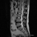 허리디스크 치료사례-5요추 4-5번간 추간판탈출증(한*재님 남자/30세) 치료전-후MRI비교 이미지