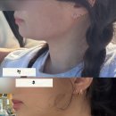 홍대피부과 울쎄라피프라임+온다후기 리프팅효과