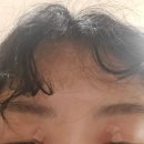 서울올업피부과의원 | 💆‍♀️ 갑자기 올라온 비립종들, "성수 서울올업피부과의원"에서 깔끔하게 제거!