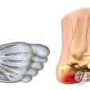 &#34;타이거우즈도 절게 한 &#39;족저근막염&#39;…생활 속 원인 찾아야 이미지