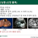 신장 낭종 증상 및 원인과 치료 : 콩팥 물혹 이미지