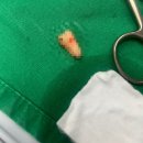 🦷12월(드디어 사랑니 발치하다..@잎사귀치과)