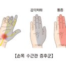 오른쪽 왼쪽 손목 통증 원인 이미지