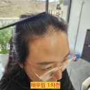 전주채우림 | 전주 탈모 커버 전주 두피 커버 헤어라인 전주채우림 3차 솔직 후기 루체아뷰티