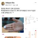 항문침이 도대체 뭐길래 feat.윤석열 이미지