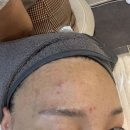파브온스킨 | 신대방삼거리피부관리 파브온스킨에서 여드름재생플라즈마관리 후기