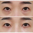 눈밑지방재배치 효과와 비용, 하안검수술이랑 뭐가 틀릴까요?
