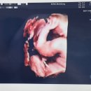 마동-36 | [#이대목동시험관1차]36주차 임산부 이대목동 막달 검사 후기, 빈혈이슈