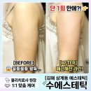 정관장삼계점 | [김해 수에스테틱] 팔뚝 때문에 나시 못 입는 사람 필독! 김해 삼계동 수에스테틱 티리온X 관리 후기