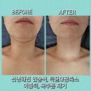 롯데마트 앞 사거리 | #크레이지리프팅 #물방울리프팅 #산소테라피 #군산피부샵 보금뷰티 후기