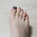 (주)네오메드 | 무지외반증 발가락교정기 네오 발미소 사용기