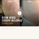 모아에스테틱 후기 | 피부과에 몇 백 쓰고 정착한 트러블 관리샵